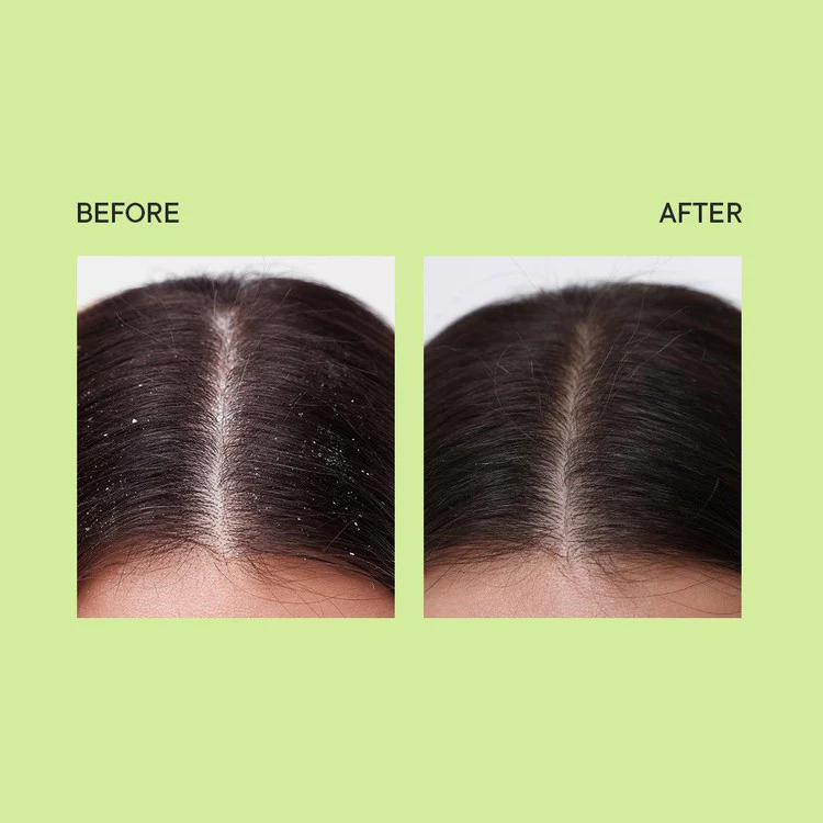 Dandruff Control Scalp Scrub with Tea Tree Extracts - 200 ML - Image 6