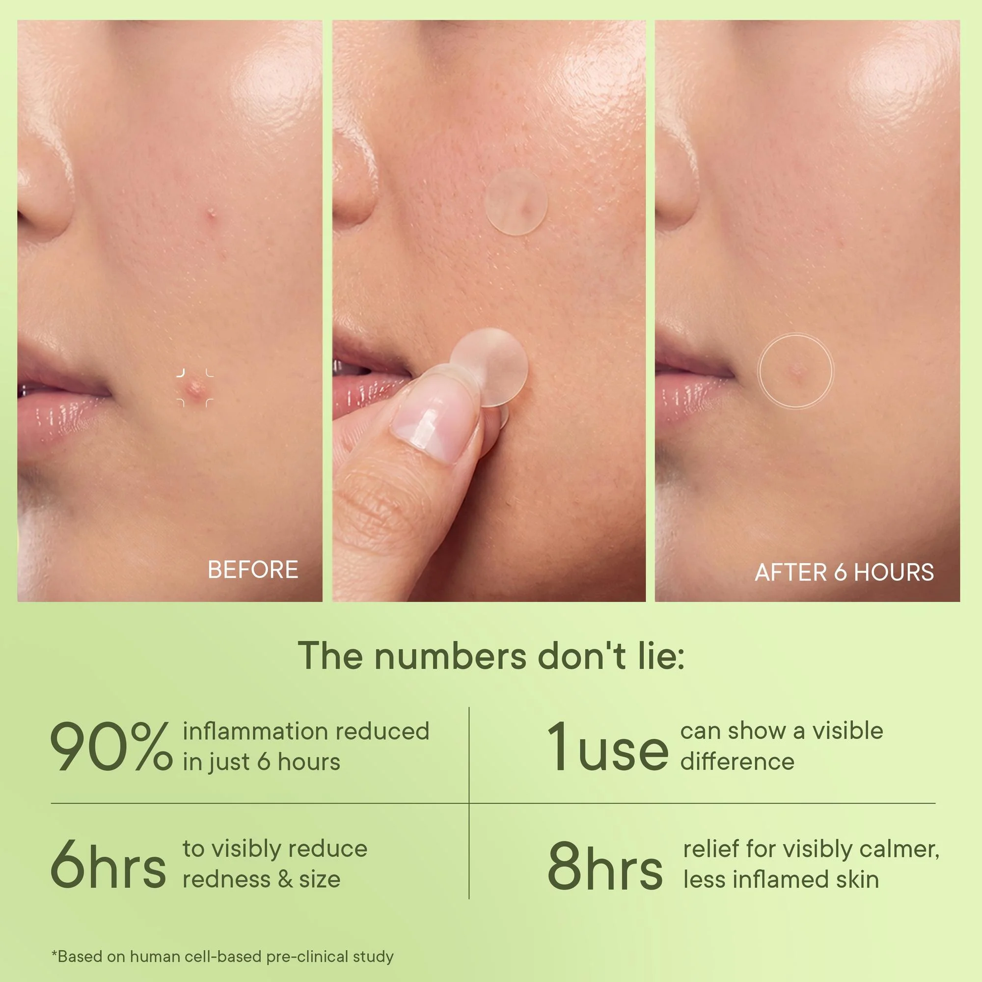 Zit Away Treatment Patches with Cica Herb Repair - Pack of 1 (24 PATCHES) - Image 3